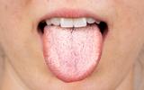 É raro, mas acontece muito: O que significa ter uma língua branca? Entenda causas e saiba como combater em poucos dias