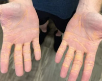 Colesterol saindo pela pele: homem devora carne, quilos de queijo e manteiga e acaba com uma infiltração de gordura num nível quase irreversível