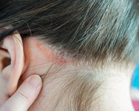 Segundo recente estudo inglês, a psoríase pode ser agravada por esses hábitos alimentares