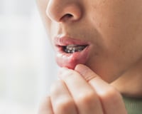 Como aliviar a afta em casa? TudoGostoso explica quais alimentos evitar e o que pode ajudar