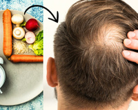 Com medo de ficar calvo? Dieta queridinha da internet pode aumentar as chances disso acontecer, segundo novo estudo