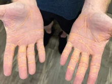 Colesterol saindo pela pele: homem devora carne, quilos de queijo e manteiga e acaba com uma infiltração de gordura num nível quase irreversível