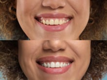 O chá que ajuda a eliminar e prevenir o tártaro nos dentes: como consumir a infusão que ajuda a controlar bactérias na saúde bucal