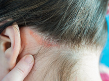 Segundo recente estudo inglês, a psoríase pode ser agravada por esses hábitos alimentares