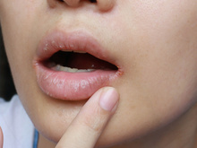 O que você come pode salvar seus lábios ressecados no frio: veja que alimentos apostar ou evitar