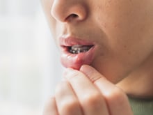 Como aliviar a afta em casa? TudoGostoso explica quais alimentos evitar e o que pode ajudar
