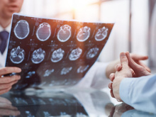 Cientistas acabam de descobrir um grande problema com as recomendações de vitamina B12 - e seu cérebro pode estar em risco