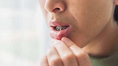 Como aliviar a afta em casa? TudoGostoso explica quais alimentos evitar e o que pode ajudar
