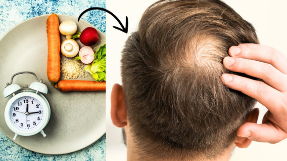 Com medo de ficar calvo? Dieta queridinha da internet pode aumentar as chances disso acontecer, segundo novo estudo