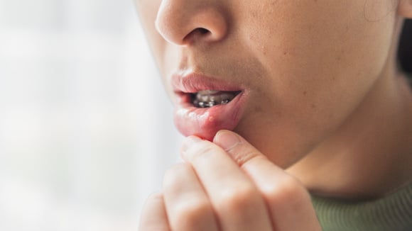 Como aliviar a afta em casa? TudoGostoso explica quais alimentos evitar e o que pode ajudar