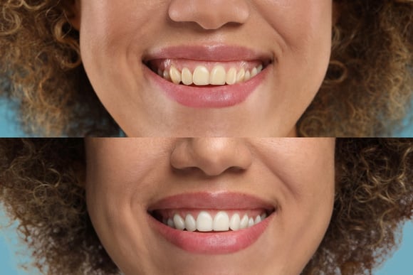 O chá que ajuda a eliminar e prevenir o tártaro nos dentes: como consumir a infusão que ajuda a controlar bactérias na saúde bucal