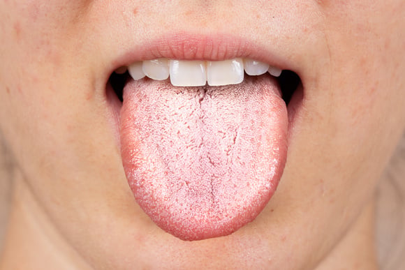 É raro, mas acontece muito: O que significa ter uma língua branca? Entenda causas e saiba como combater em poucos dias