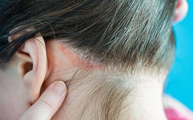 Segundo recente estudo inglês, a psoríase pode ser agravada por esses hábitos alimentares