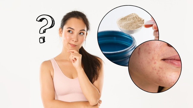 Descubra se Whey protein causa acne e outros 3 fatos que você não sabia sobre o suplemento