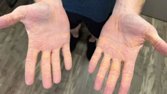 Colesterol saindo pela pele: homem devora carne, quilos de queijo e manteiga e acaba com uma infiltração de gordura num nível quase irreversível