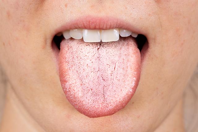 É raro, mas acontece muito: O que significa ter uma língua branca? Entenda causas e saiba como combater em poucos dias
